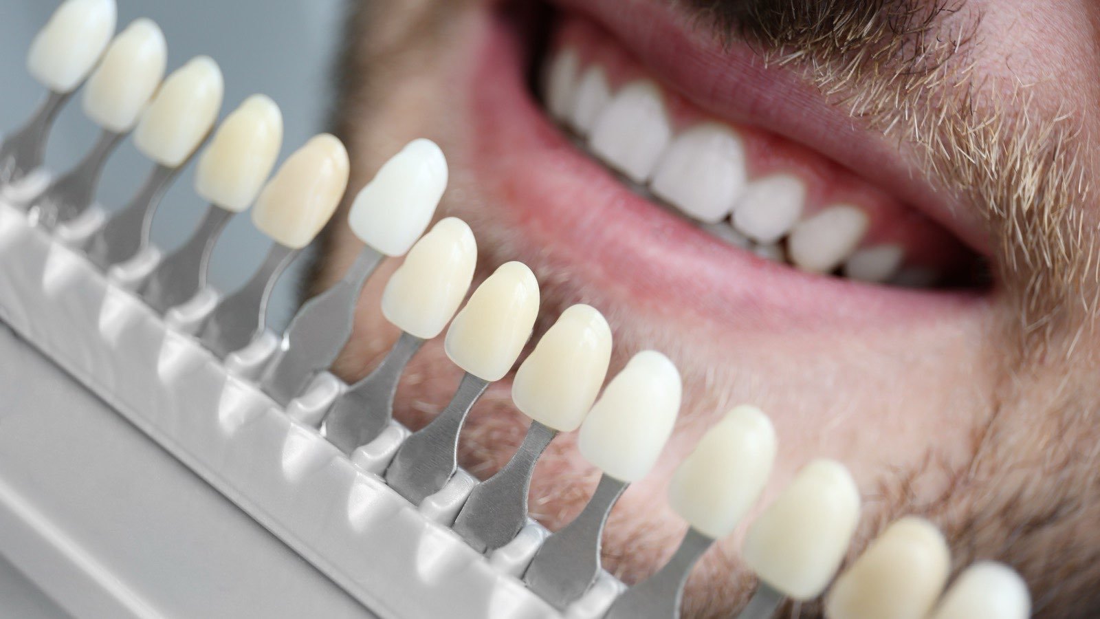 A dental shade guide held against a smile to match the colour of a restoration